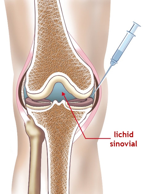 acid hialuronic in genunchi